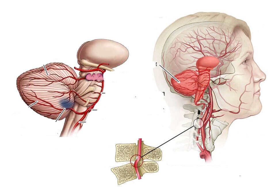 Senchebell I Ischemia